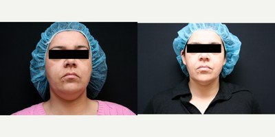 עיצוב גוף — before and after