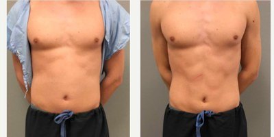 עיצוב גוף — before and after