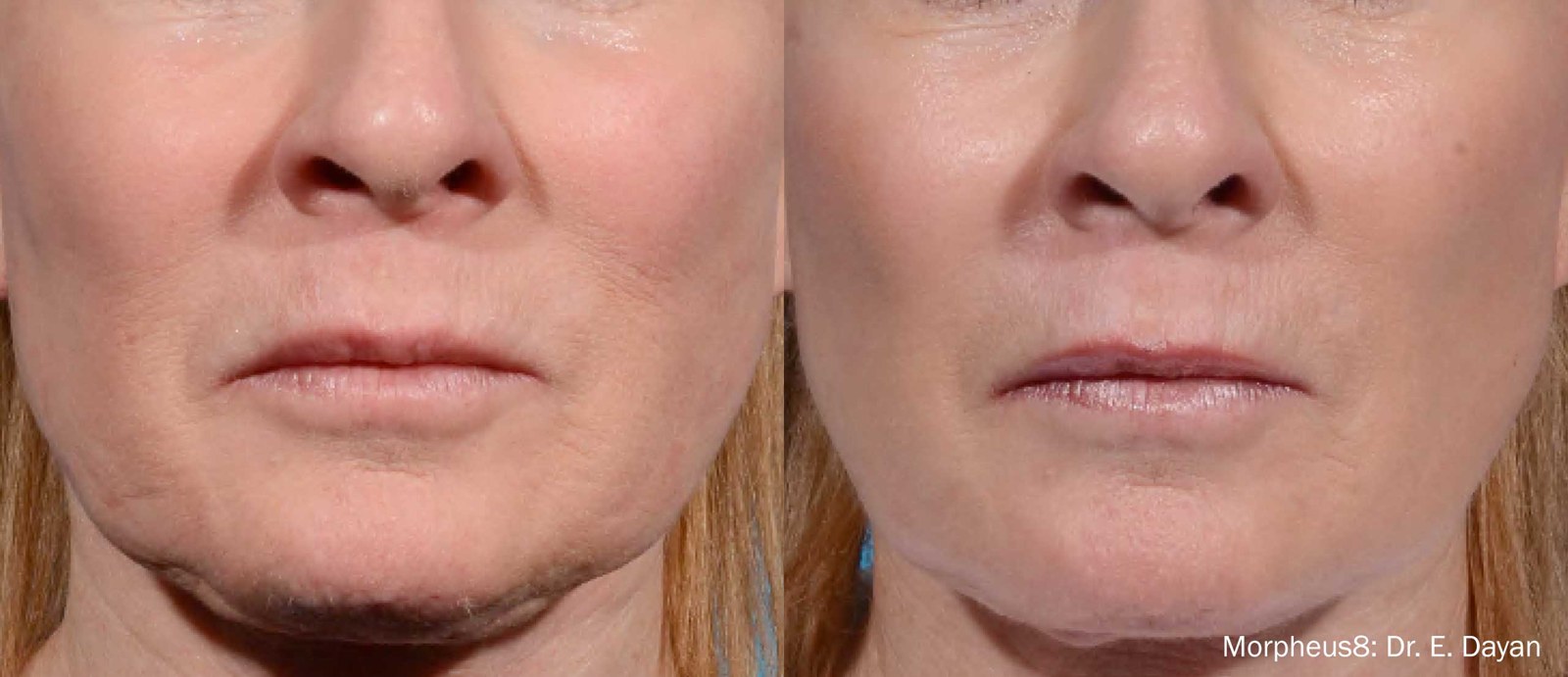 עיצוב סנטר וקו לסת (בשילוב FaceTite) — before and after