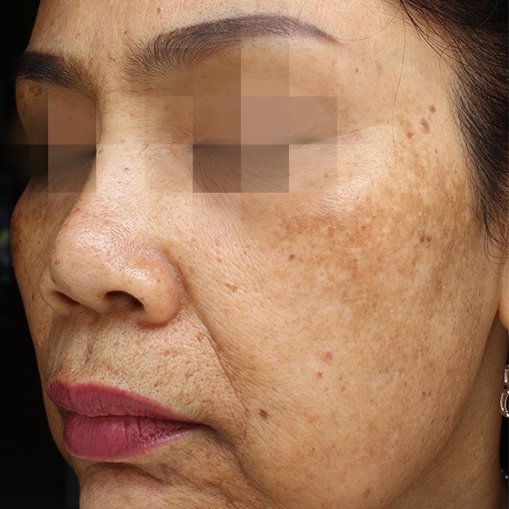 פיגמנטציה — before