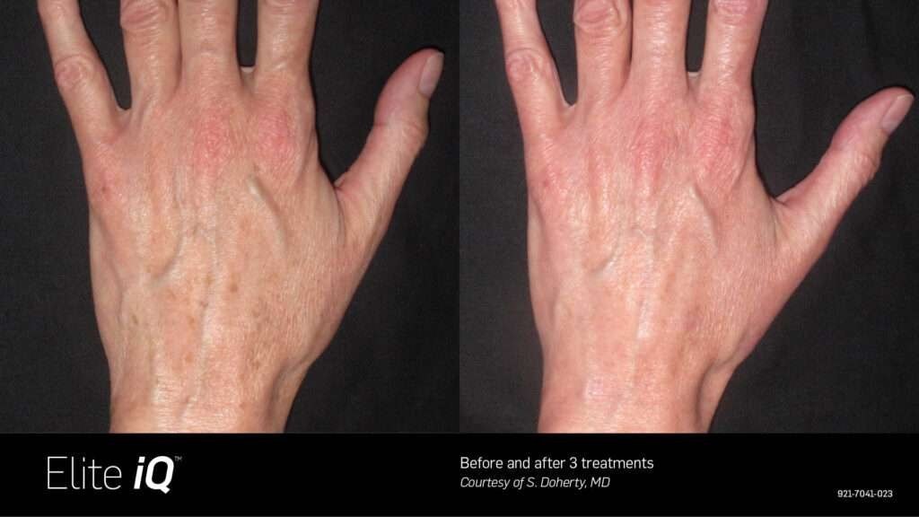 הסרת שיער — before and after