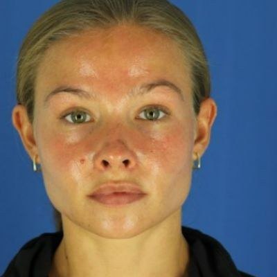 Acne & Scars — before