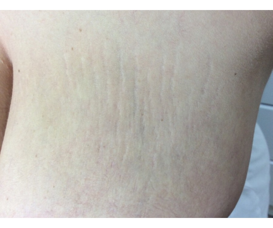 סימני מתיחה — before