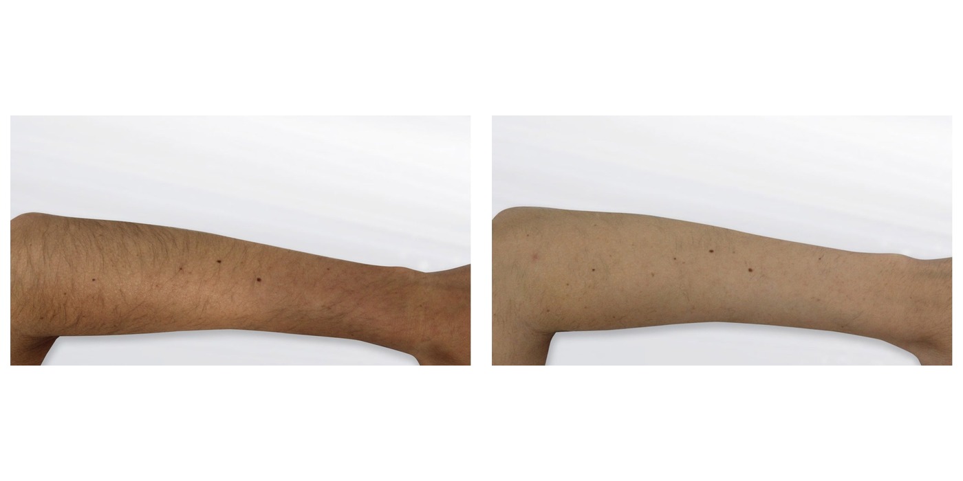 הפחתת שיער קבועה — זרוע — before and after