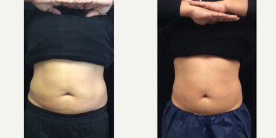 עיצוב גוף — before and after
