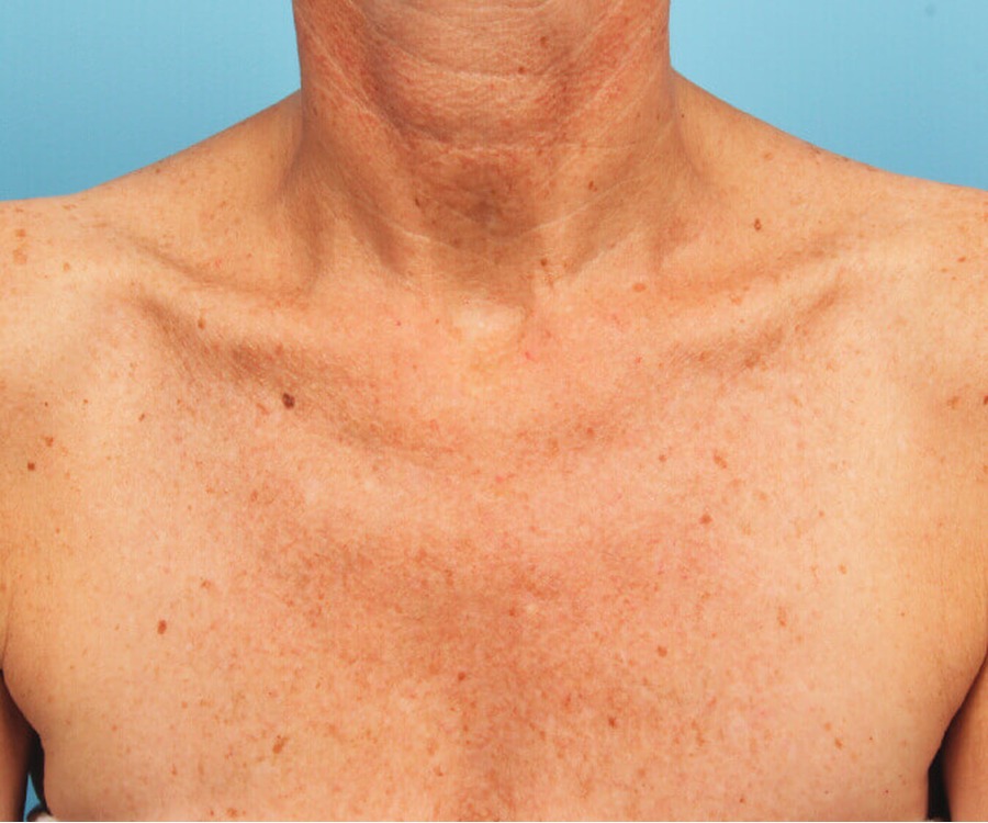 נזקי שמש ופיגמנטציה — before