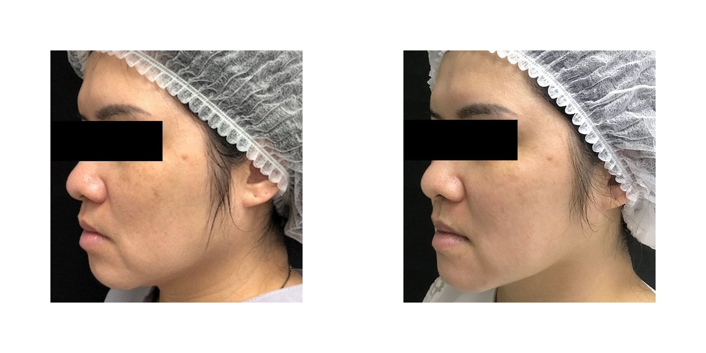 TriBella — גוון, אלסטיות ומרקם — before and after