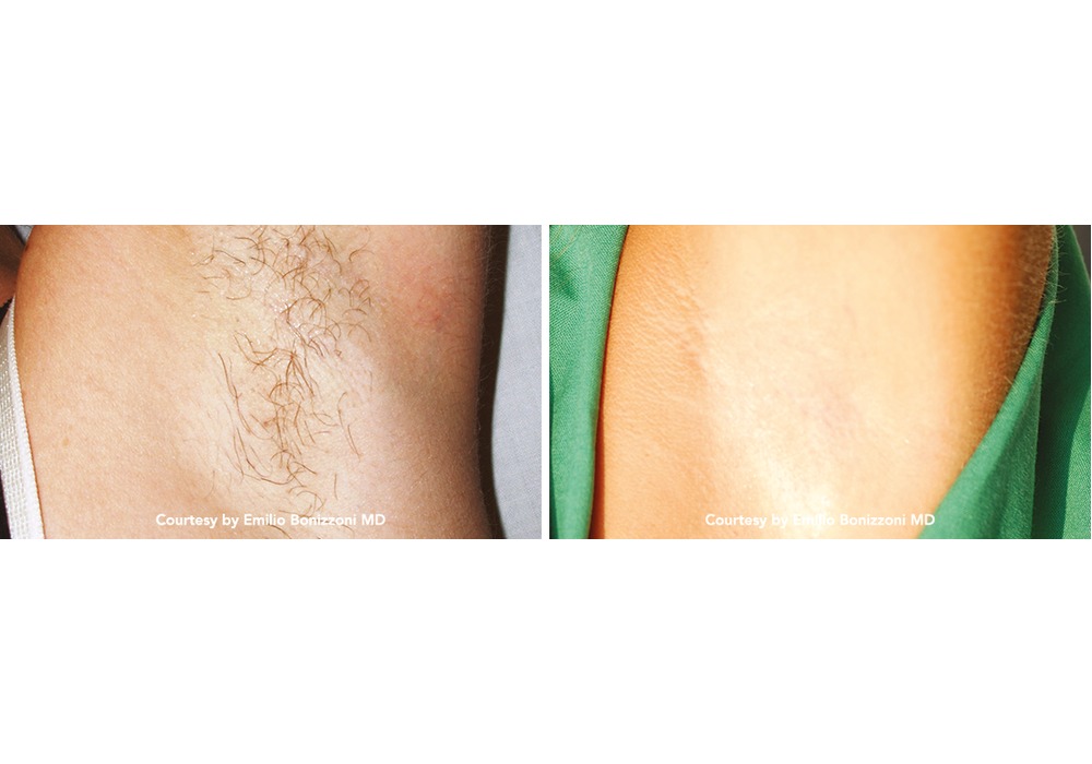 הסרת שיער קבועה — before and after