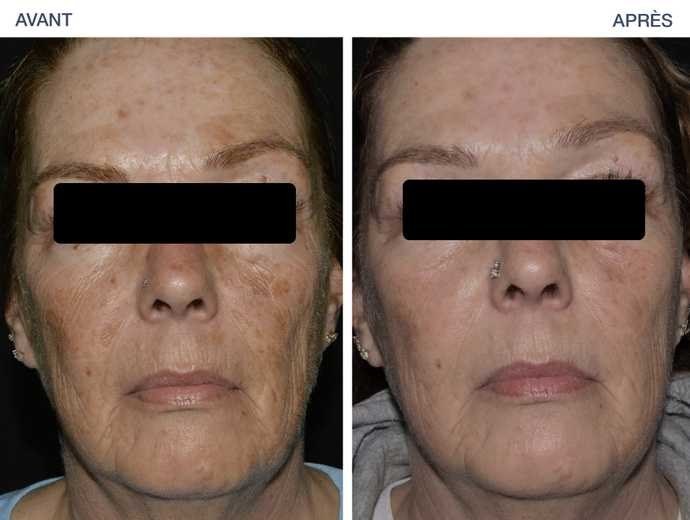 Skin Resurfacing — before and after