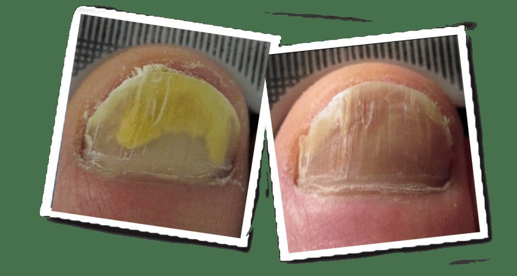 Nail Fungus — before and after