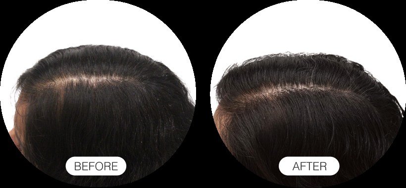 Hair Growth — before and after
