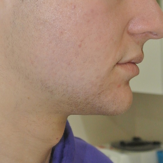 אקנה וצלקות — after