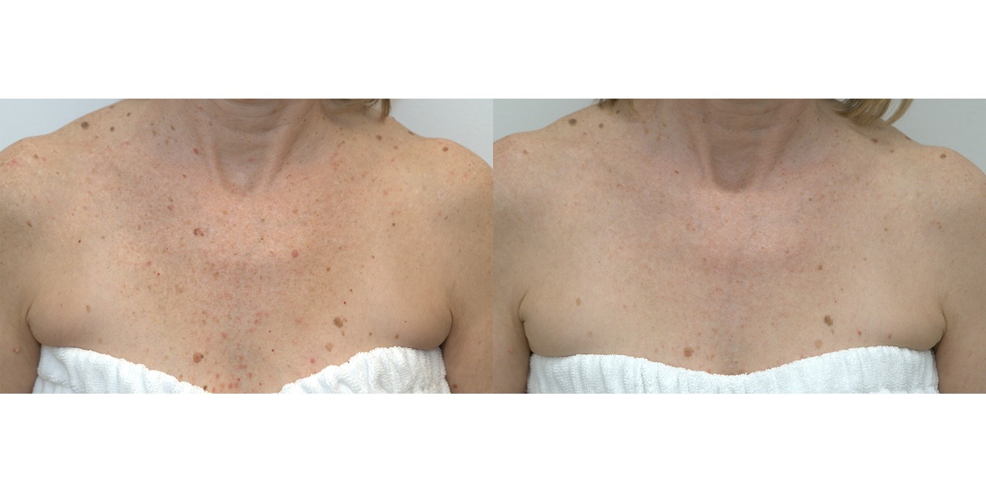 BBL HEROic — נזקי שמש בחזה — before and after