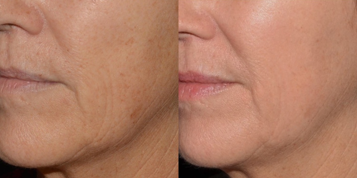Tone & texture / sun damage — before and after