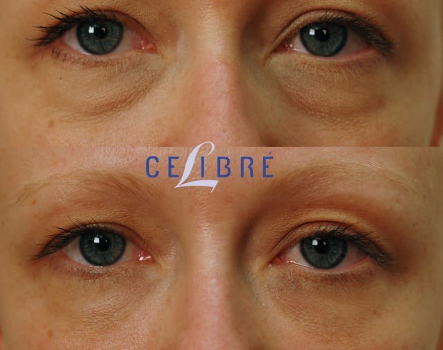 חידוש עור — before and after