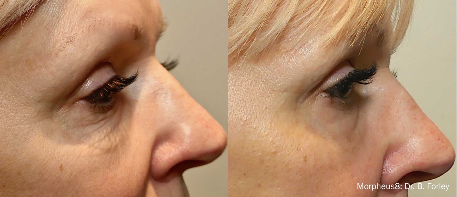 מיצוק עור סביב העיניים — before and after