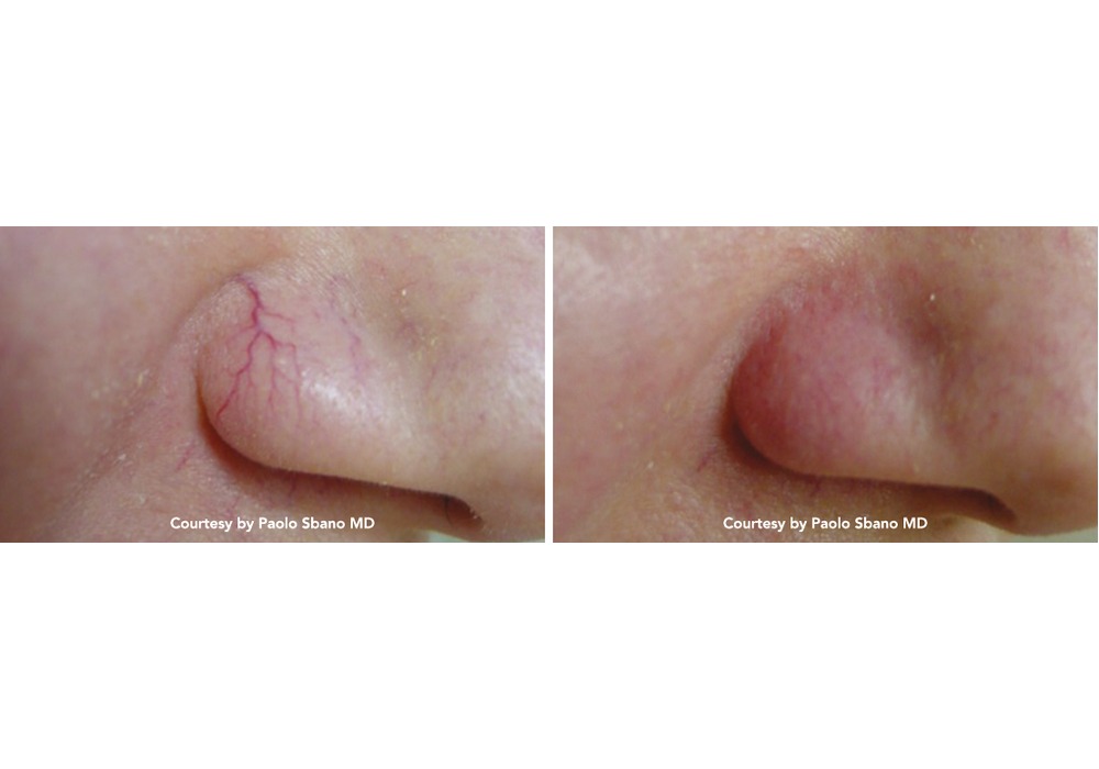 נגעים וסקולריים — before and after