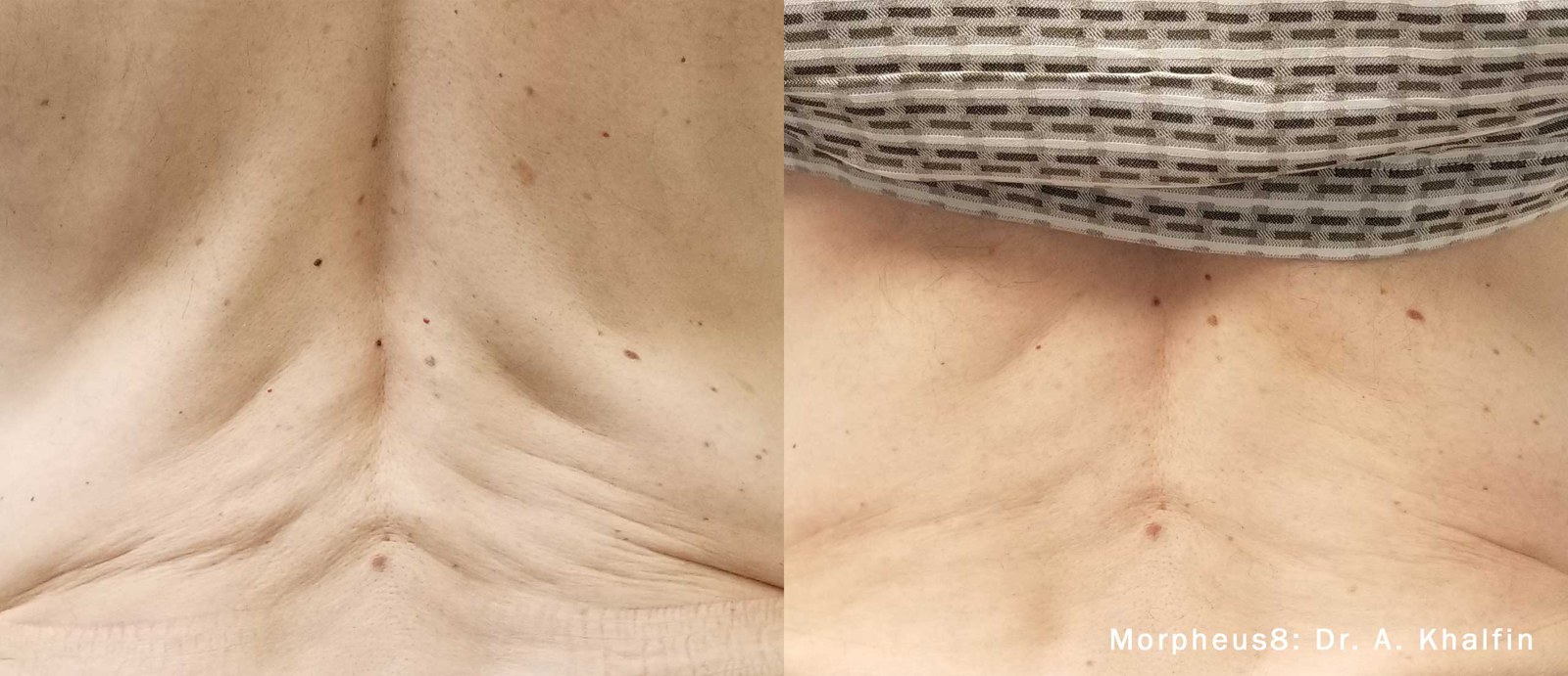 עיצוב עור הגב — before and after