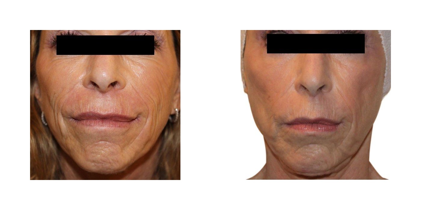 הפחתת קמטים — before and after