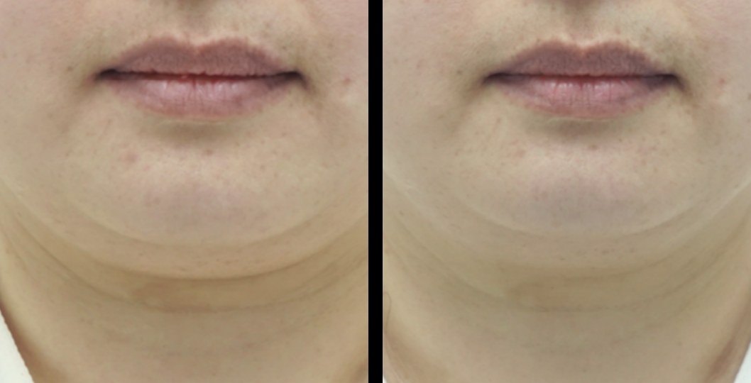 עיצוב גוף — before and after