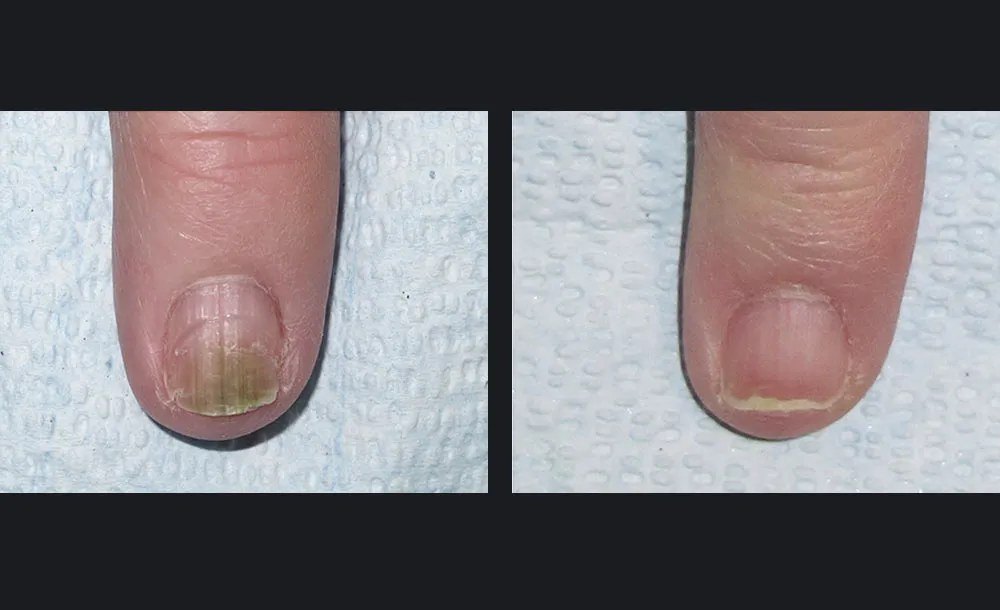 פטרת ציפורניים — before and after