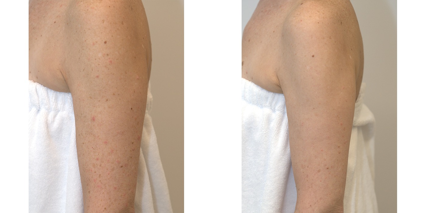 BBL HEROic — הבהרת פיגמנטציה בזרועות — before and after