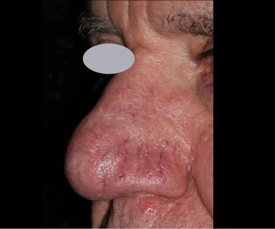 נגעים וסקולריים — before