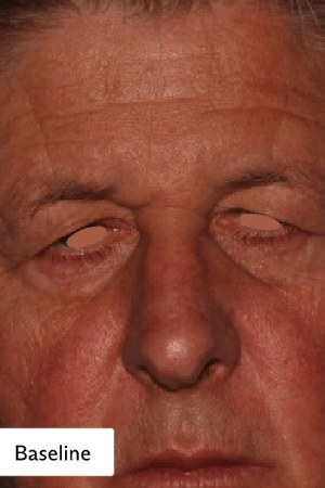 קמטים עמוקים בפנים — before
