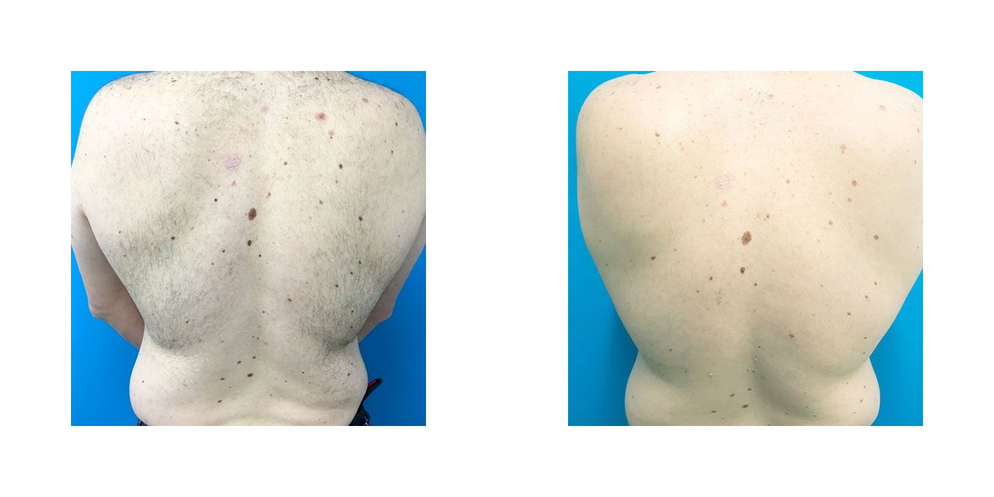 הסרת שיער — גב מלא — before and after