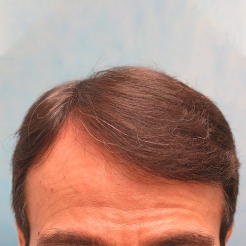 צמיחת שיער — before and after