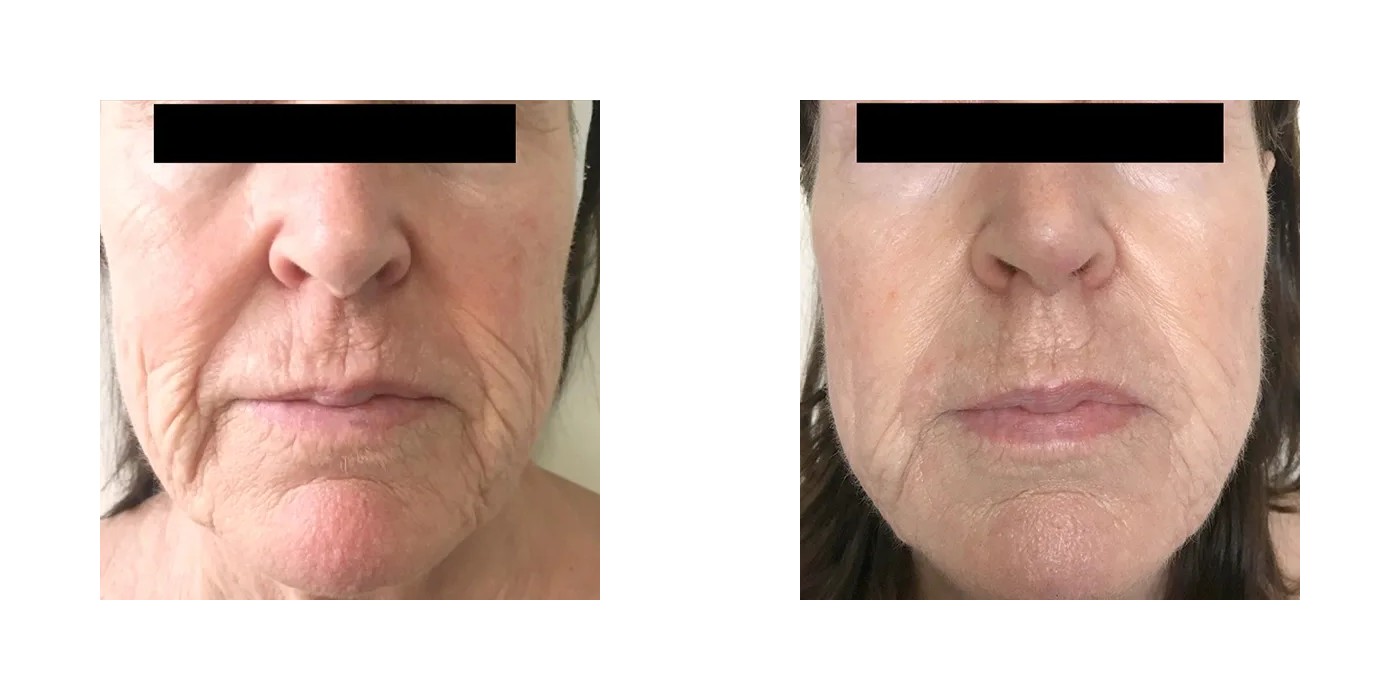 TriBella — רפיון בקו הלסת וקווים דקים — before and after