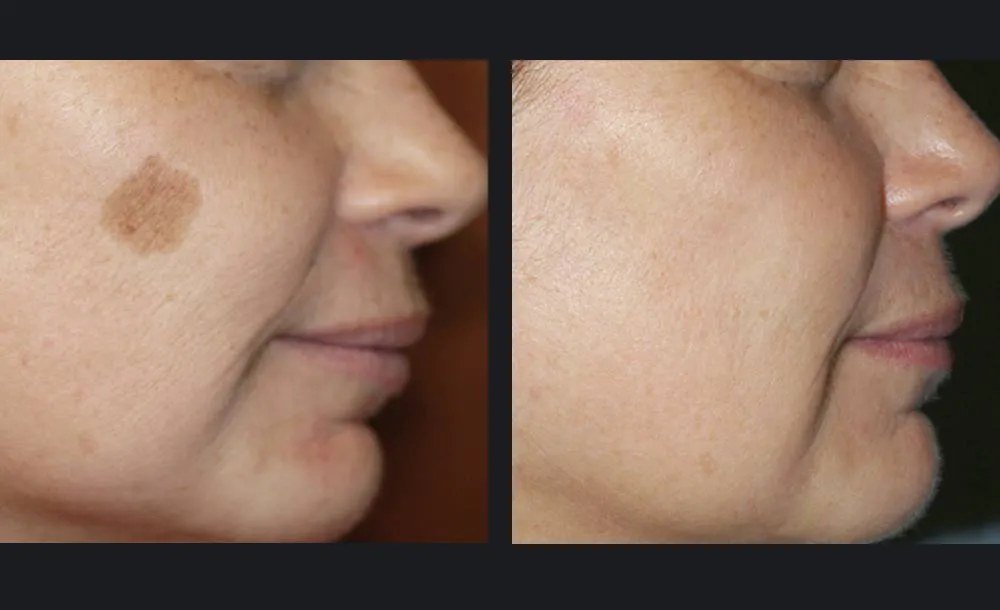 פיגמנטציה — before and after