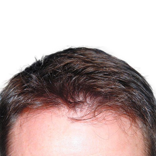 צמיחת שיער — after