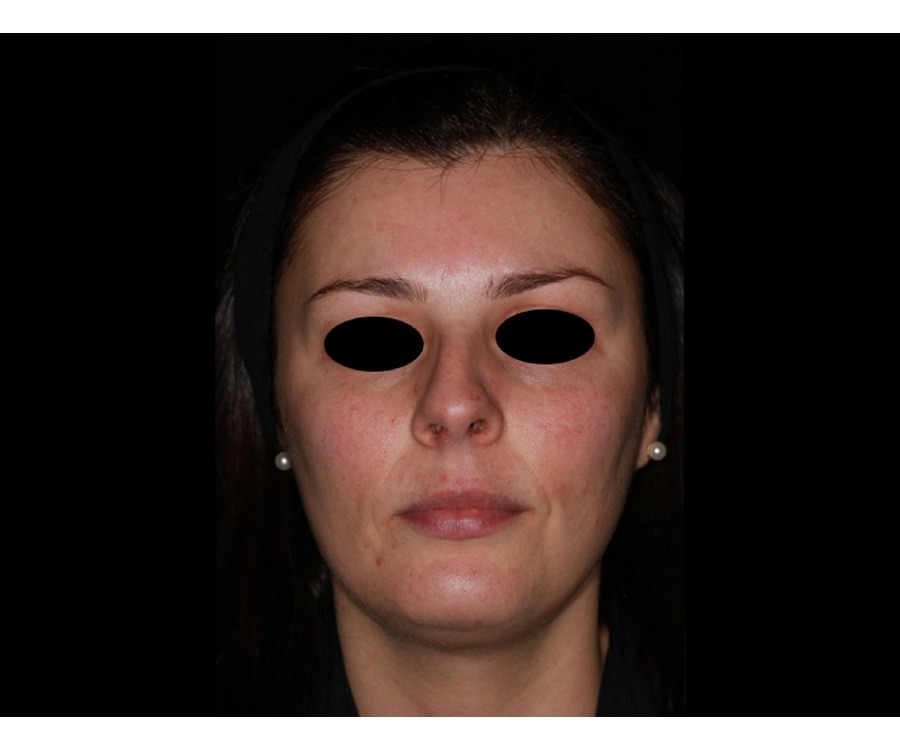 Photofractional (XPL + ResurFX) — before