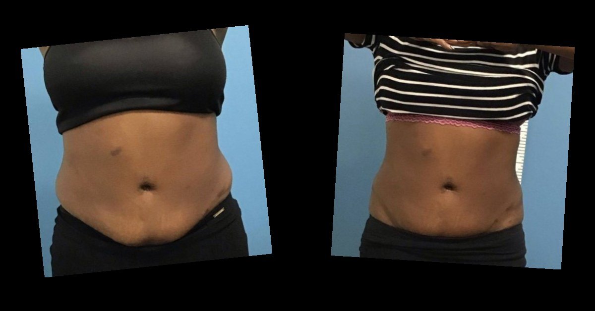 Body Contouring — before and after