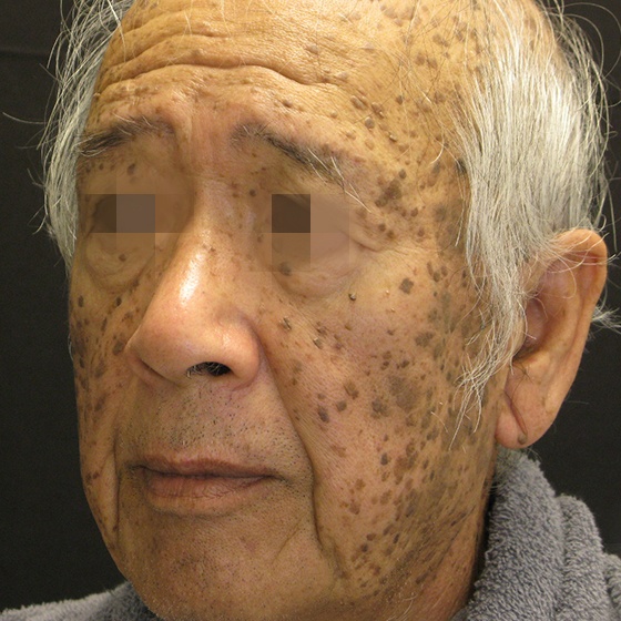 פיגמנטציה — before