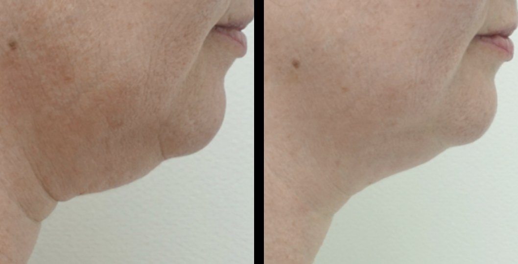 עיצוב גוף — before and after