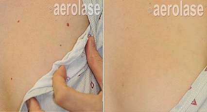Vascular Lesions — before and after