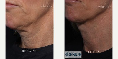 מיצוק עור — before and after