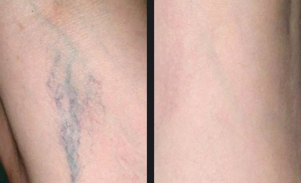 נגעים וסקולריים — before and after