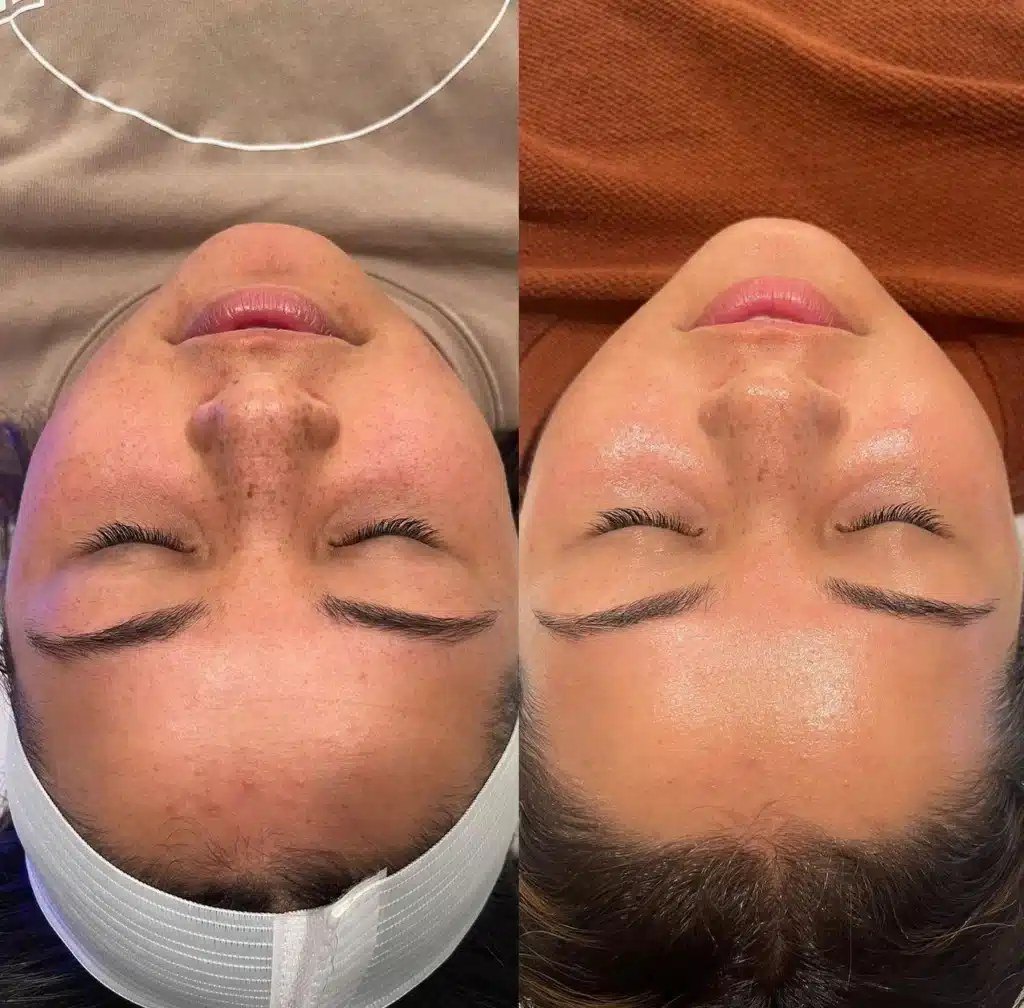 הסרת שיער — before and after