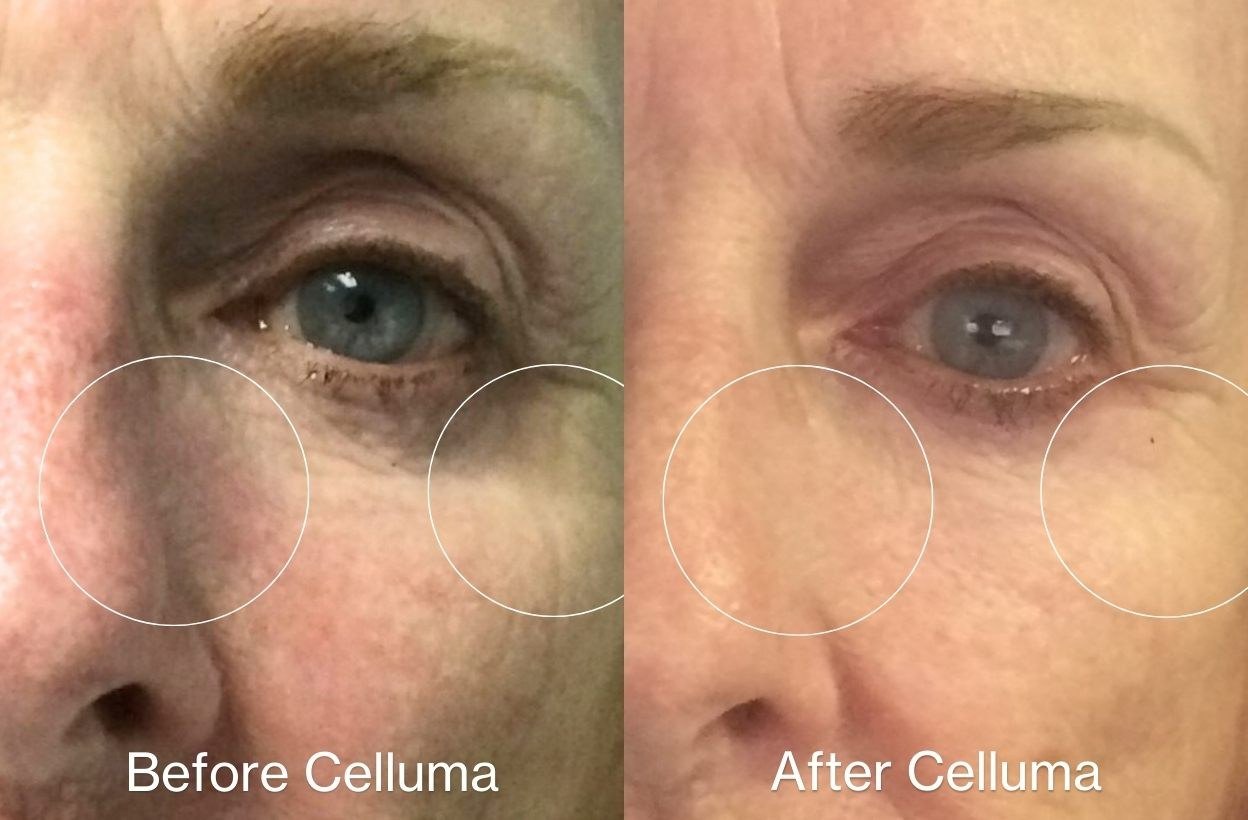 חידוש עור — before and after