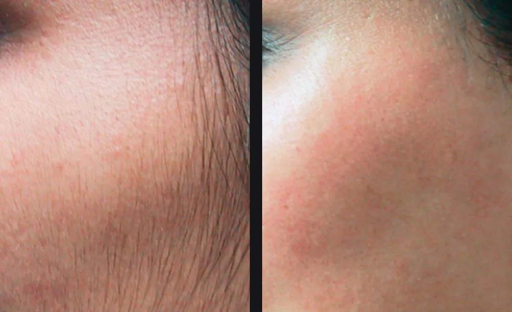 הסרת שיער — before and after