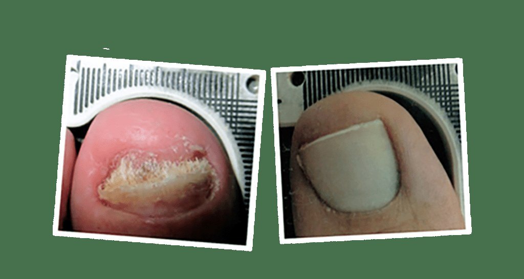Nail Fungus — before and after