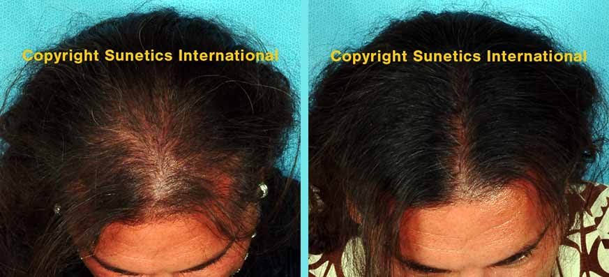 Hair Growth — before and after