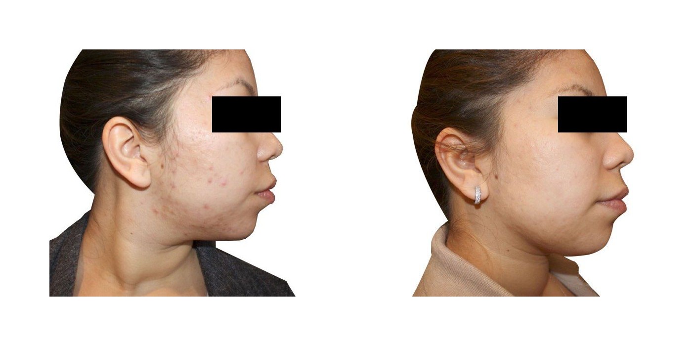 הפחתת אקנה — before and after