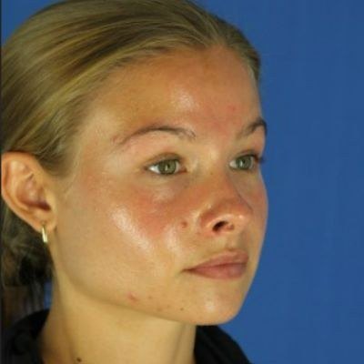 Acne & Scars — before