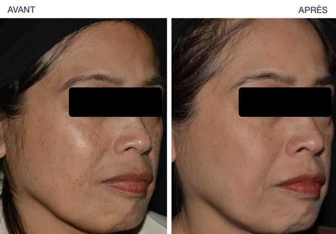 Skin Resurfacing — before and after