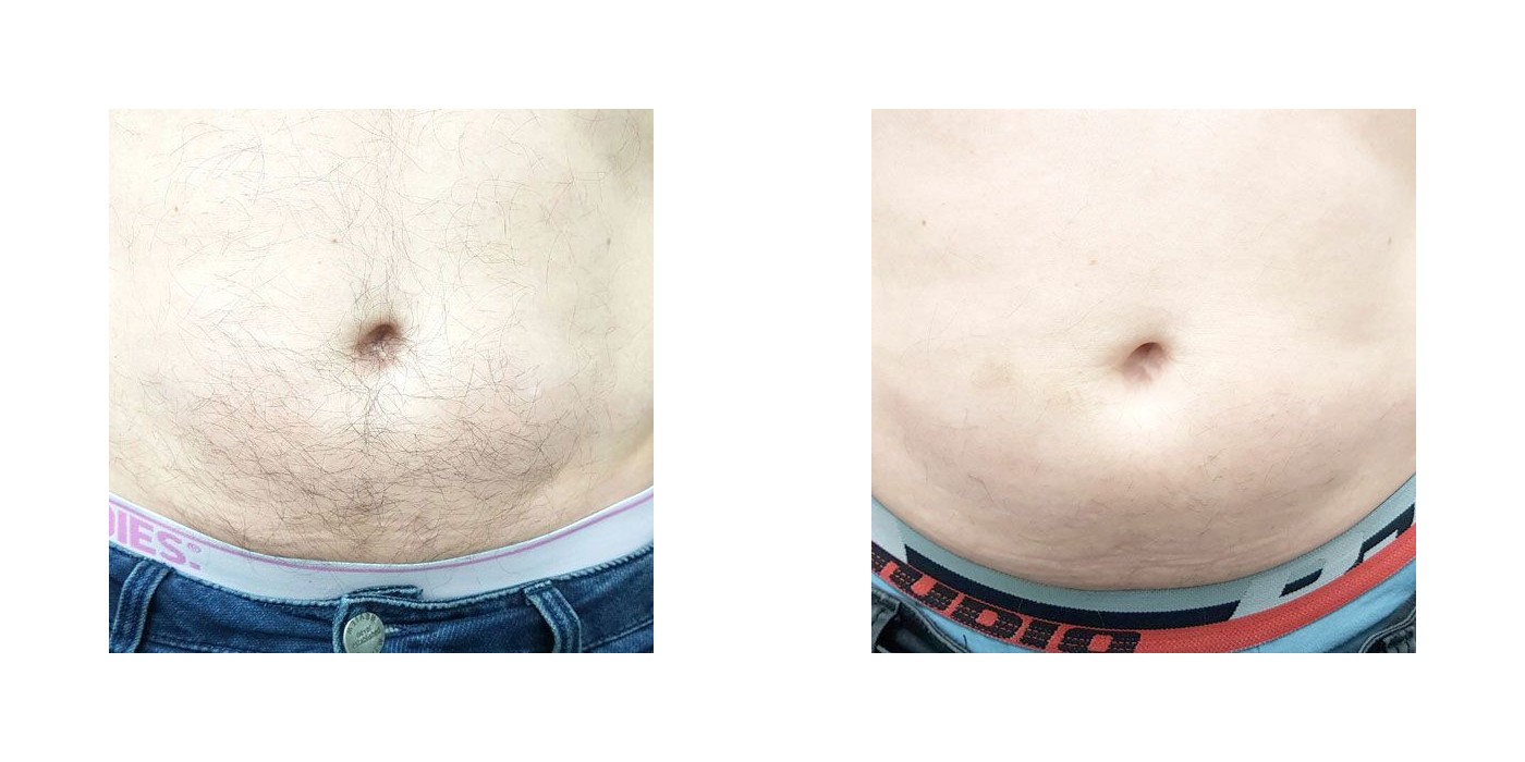 הסרת שיער — בטן — before and after