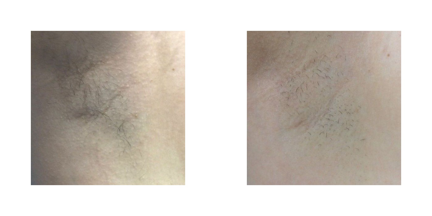 הסרת שיער — בית שחי — before and after